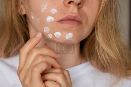 Photo for Unrecognizable woman applies makeup, cream serum cure for acne on face. Close-up acne on womans face with rash skin ,scar and spot that allergic to cosmetics. Problem skincare and health concept - Royalty Free Image