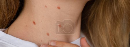 Unerkennbare Frau, die ihre Geburtsmale auf der Nackenhaut zeigt Nahaufnahme Detail der nackten Haut Sonnenexposition Wirkung auf die Haut, Banner Gesundheitseffekte der UV-Strahlung Frau mit Muttermalen Pigmentierung und viel