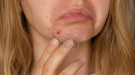 Unrecognizable woman upset smiling showing her acne on face. Acceptance real skin imperfection Close-up acne on womans face with rash skin ,scar and spot that allergic to cosmetics. Problem skincare
