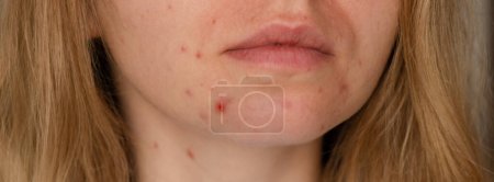 Foto de Unrecognizable woman showing her acne on face. Close-up acne on woman's face with rash skin ,scar and spot that allergic to cosmetics. Banner Problem skincare and health concept. Wrinkles, melasma, dark spots, freckles, dry skin, acne blackheads on f - Imagen libre de derechos