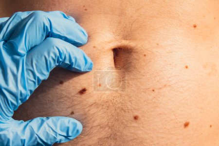 Photo for Doctor in medical gloves examining man skin mole. Dermatologist checking male birthmarks. Self care preventing cancer procedure. Protection treatment. Imperfection skin positivity - Royalty Free Image