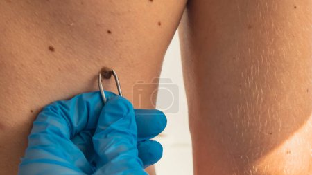 Photo for Doctor in medical gloves examining man skin mole for size. Dermatologist checking male birthmarks. Self care preventing cancer procedure. Protection treatment. Imperfection skin positivity - Royalty Free Image
