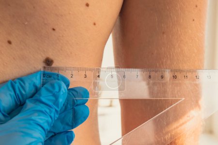 Dermatologe überprüft die Größe männlicher Muttermale mit Lineal. Arzt untersucht Länge und Breite gutartiger Muttermale auf der menschlichen Haut Pigmentierung. 