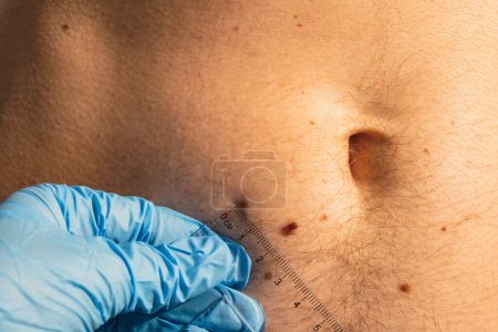 Photo for Dermatologist checking sizes of male birthmarks with ruler. Doctor examining length and width of benign moles on man skin Pigmentation. - Royalty Free Image