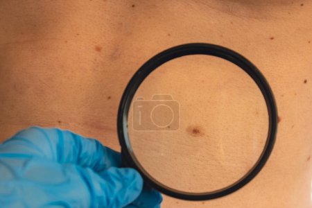 Mole dermoscopy, preventive of melanoma. Dermatologist examining patients birthmark with magnifying glass in clinic. Checking benign moles. Skin abnormalities care concept.