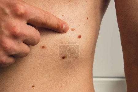 Männliche Hand mit Muttermalen auf der Haut Körperbauchteil. Detailaufnahme der nackten Haut. Gesundheitliche Auswirkungen der UV-Strahlung. Mann mit Muttermalen Pigmentierung und viele Muttermale