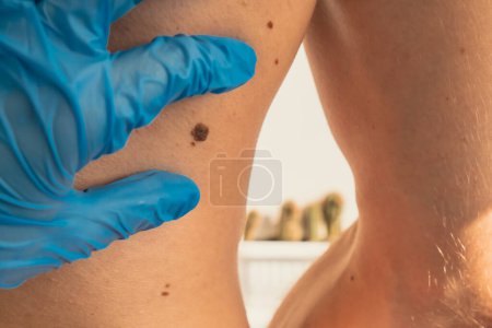 Photo for Dermatologist checking male birthmarks for changing size. Annual rechecking. Doctor in medical gloves examining man skin mole. Self care preventing cancer procedure. Protection treatment. Imperfection - Royalty Free Image