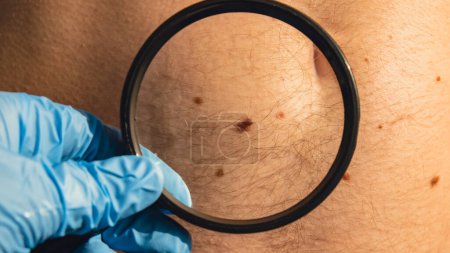 Photo for Mole dermoscopy, preventive of melanoma. Dermatologist examining patients birthmark with magnifying glass in clinic. Checking benign moles. Skin abnormalities care concept. - Royalty Free Image