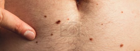 Unerkennbarer Mann, der seine Muttermale auf der Haut zeigt Nahaufnahme Detail der nackten Haut Sonneneinwirkung auf die Haut. Gesundheitliche Auswirkungen der UV-Strahlung Männchen mit Muttermalen Pigmentierung und viele Muttermale