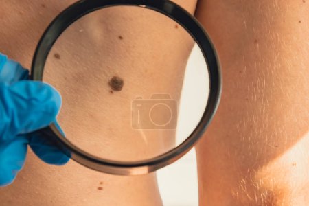 Photo for Mole dermoscopy, preventive of melanoma. Dermatologist examining patients birthmark with magnifying glass in clinic. Checking benign moles. Skin abnormalities care concept. - Royalty Free Image