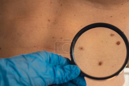 Photo for Unrecognizable Dermatologist examining patients birthmark with magnifying glass in clinic. Mole dermoscopy, preventive of melanoma. Checking benign moles. Skin abnormalities care concept. - Royalty Free Image
