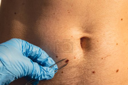 Photo for Doctor in medical gloves examining man skin mole for size. Dermatologist checking male birthmarks. Self care preventing cancer procedure. Protection treatment. Imperfection skin positivity - Royalty Free Image