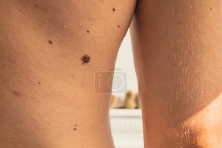 Téléchargez les photos : Homme montrant des taches de naissance sur le dos du corps de la peau. Détail rapproché de la peau nue. Effets du rayonnement UV sur la santé. Homme avec des taches de naissance Pigmentation et beaucoup de taches de naissance - en image libre de droit