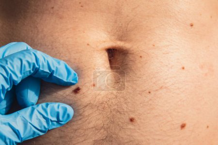 Photo for Dermatologist checking male birthmarks. Doctor in medical gloves examining man skin mole. Self care preventing cancer procedure. Protection treatment. Imperfection skin positivity - Royalty Free Image