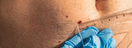 Photo for Unrecognizable Doctor in medical gloves examining length and width of benign moles on man skin. Dermatologist checking male birthmarks with ruler. Pigmentation. - Royalty Free Image