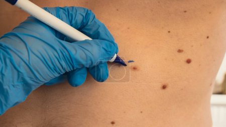 Photo for Doctor in medical gloves paint lines around male birthmarks. Preparing procedure for medical surgery. Laser skin tags removal. Prevention of melanoma and nevus exam - Royalty Free Image