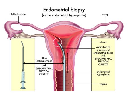 Medical illustration of the endometrial biopsy procedure with annotations