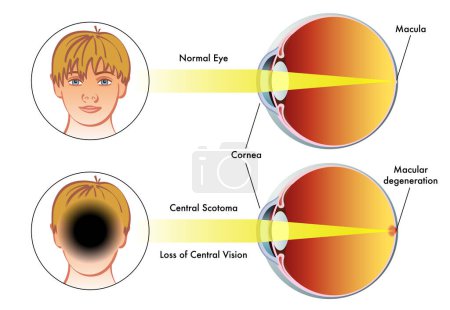 Ilustración médica compare un ojo humano con un escotoma central, con un ojo normal.