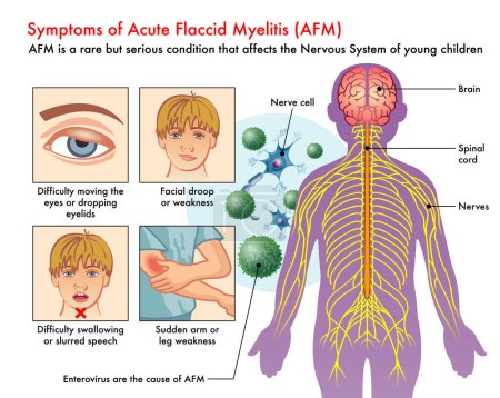 Medical illustration of Symptoms of Acute Flaccid Myelitis, AFM, with annotations.