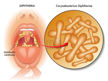 Ilustración médica de síntomas de difteria, con anotaciones.