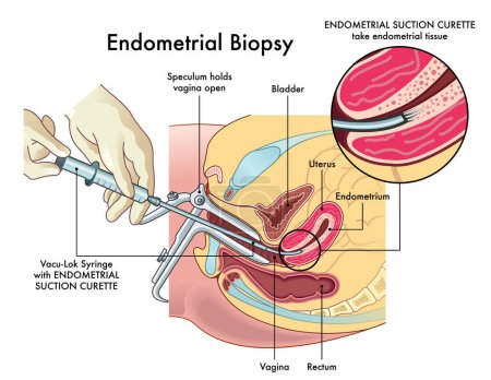 Medical illustration of the endometrial biopsy procedure with annotations