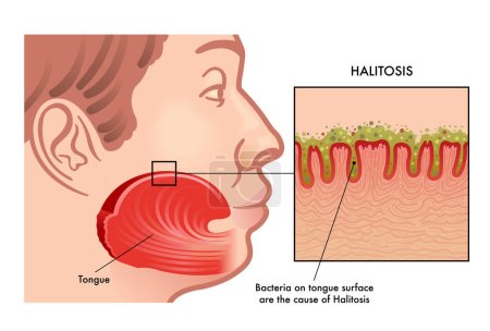 Ilustración médica de la causa de la Halitosis
