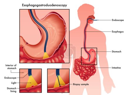 Ilustración médica de una esofagogastroduodenoscopia con dos detalles que muestran el procedimiento y los instrumentos utilizados, con anotaciones.