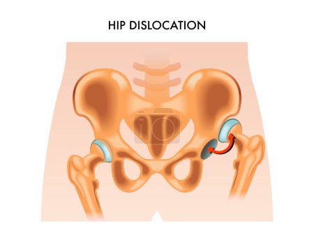 Illustration médicale de la luxation de la hanche.