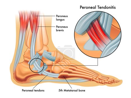 Ilustración de Ilustraciones médicas de síntomas de tendinitis peroneal, con agrandamiento de la zona afectada, con anotaciones. - Imagen libre de derechos