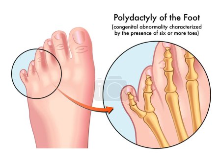 Medical illustration of a foot afflicted with Polydactyly, a congenital abnormality characterized by the presence of six or more toes, with annotations.