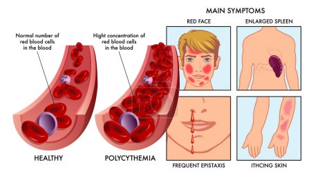 La ilustración médica compara una arteria con un número normal de glóbulos rojos, con uno afectado por la policitemia, con dibujos a la derecha que muestran síntomas, completados con anotaciones.