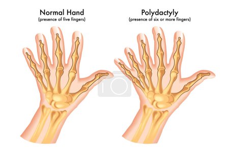 Ilustración médica de una mano afectada por polidactilia, una anomalía congénita caracterizada por la presencia de seis o más dedos.