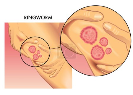 Illustration for Medical illustration of a female leg affected by ringworm, with magnified detail. - Royalty Free Image