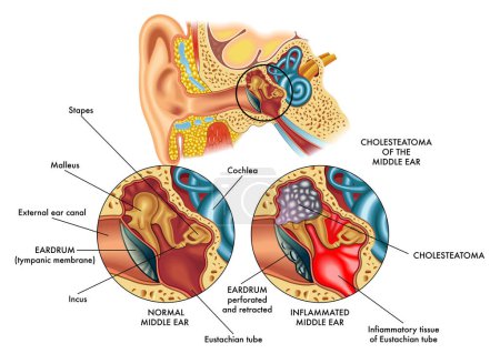 Medical illustration comparing the internal part of the ear (middle ear) on the left healthy and on the right affected by cholesteatoma, with annotations.