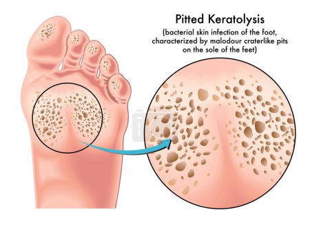 Illustration for Medical illustration of symptoms of pitted keratolysis, a bacterial skin infection of the foot. - Royalty Free Image