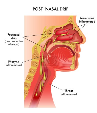 Téléchargez les illustrations : Illustration médicale des symptômes de goutte à goutte post-nasale, avec annotations. - en licence libre de droit