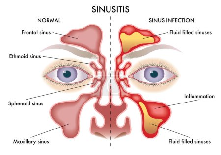 Illustration for Medical illustration of symptoms of Sinusitis. - Royalty Free Image
