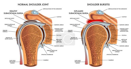 Medizinische Illustration zum Vergleich einer normalen Schulter mit einer Schleimbeutelentzündung, mit Anmerkungen.