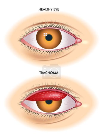 Téléchargez les illustrations : L'illustration médicale montre la comparaison entre un œil normal et un œil affecté par un trachome une maladie infectieuse causée par la bactérie Chlamydia trachomatis. - en licence libre de droit