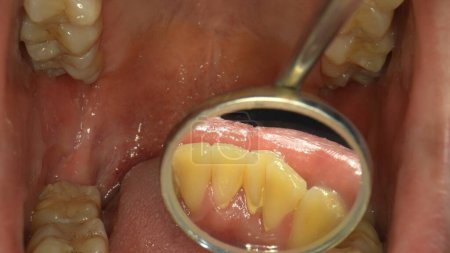 Téléchargez les photos : Le dentiste soigne les dents d'un patient. Il utilise un miroir dentaire.. - en image libre de droit