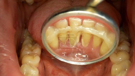 Foto de El dentista trata los dientes a un paciente. Usa un espejo dental.. - Imagen libre de derechos