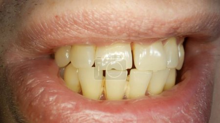 Photo for Teeth with tartar and caries, crooked lower foreground incisors, close-up. - Royalty Free Image
