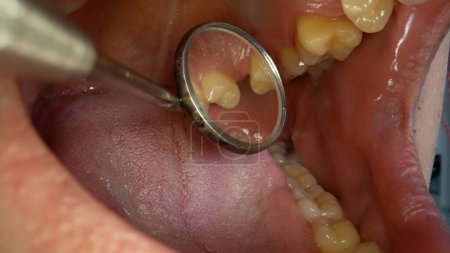 Foto de El dentista trata los dientes a un paciente. Usa un espejo dental.. - Imagen libre de derechos