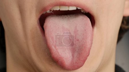 Foto de Un hombre muestra su lengua. Lengua masculina que sale de su boca. Tratamiento de enfermedades otorrinolaringológicas. Macro tiro - Imagen libre de derechos
