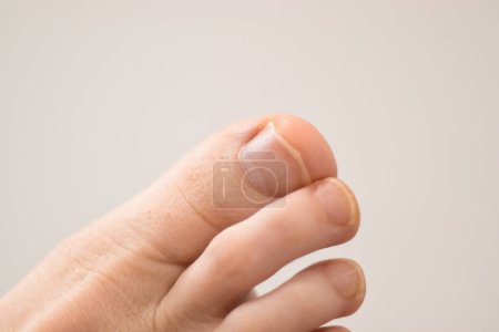 Téléchargez les photos : Gros orteil sur un pied à côté avec ongle dentelé sur un fond blanc. - en image libre de droit
