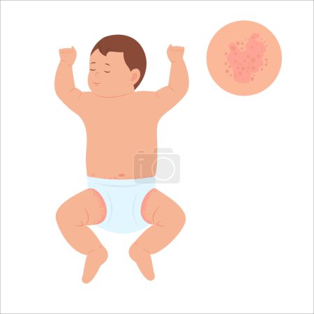 Illustration for Baby with diaper rash, skin rash, allergy. Redness of skin in children.Dermatological problems. Vector illustration - Royalty Free Image
