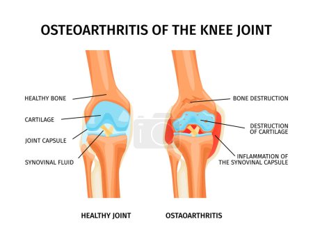 Illustration for Realistic infographics with anatomy of healthy knee and osteoarthritis of joint with labelled parts vector illustration - Royalty Free Image