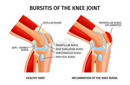 Schleimbeutelentzündung des Knies realistische Infografik mit Anatomie gesunder und ungesunder Gelenke Vektorillustration