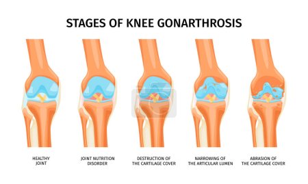 Realistische Infografiken, die Stadien der Kniegelenkarthrose vom gesunden Gelenk bis zum Abrieb des Knorpeldeckels darstellen