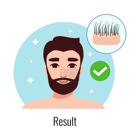 Ilustración de Alopecia hair transplantation composition with infographic image of hair restoration procedures with text vector illustration - Imagen libre de derechos